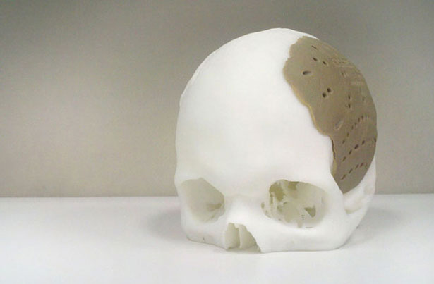 3d-printing-medical-skull-replacement