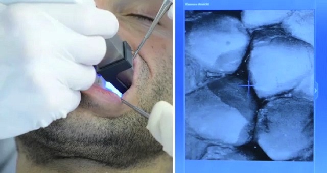 Sirona Cerec Scanning