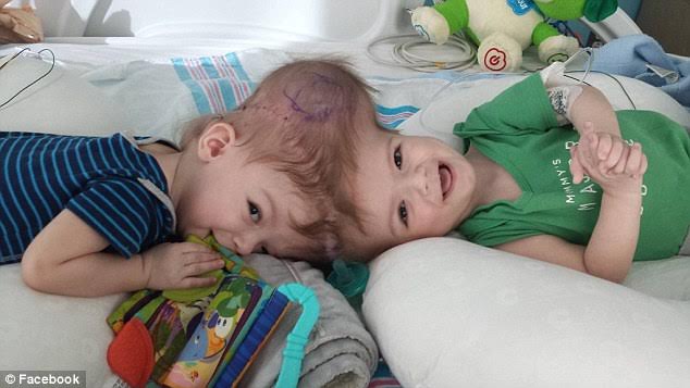 The McDonald twins before groundbreaking surgery. Photo via Facebook.