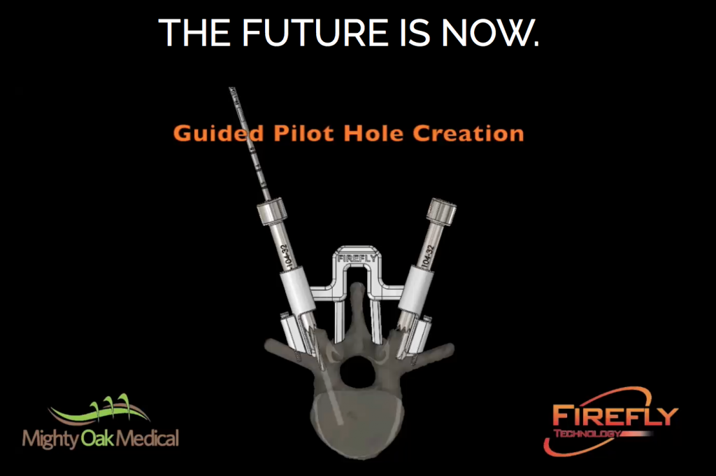 Screenshot showing how the 3D printed Firefly Technology guides aid with the creation of pilot holes in the bone. Image via: Might Oak Medical