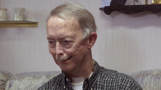 Shirley Anderson wearing the IU 3D printed jaw.